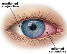 Conjunctivitis