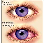 ConjunctivitisSymptoms