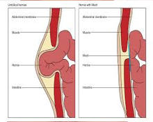 Hernia