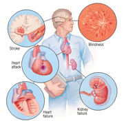 Hypertension-cause